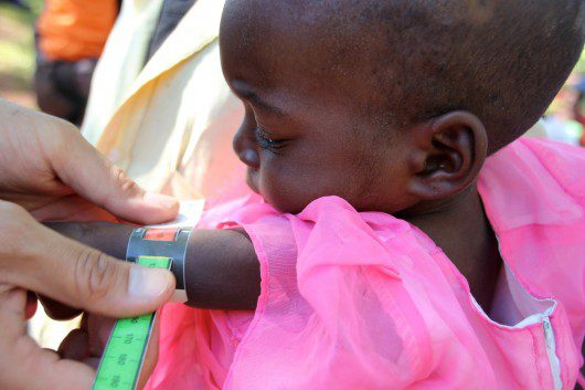 Child Malnutrition