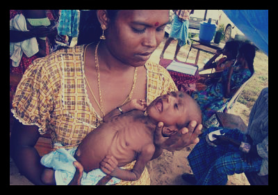 Malnutrition_children