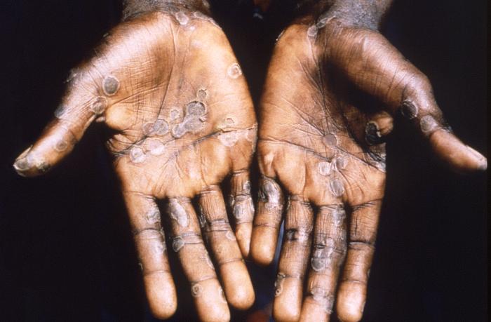 Monkeypox in Africa
