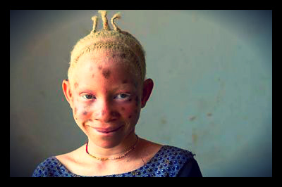 Tanzanian_Albinos_in_danger