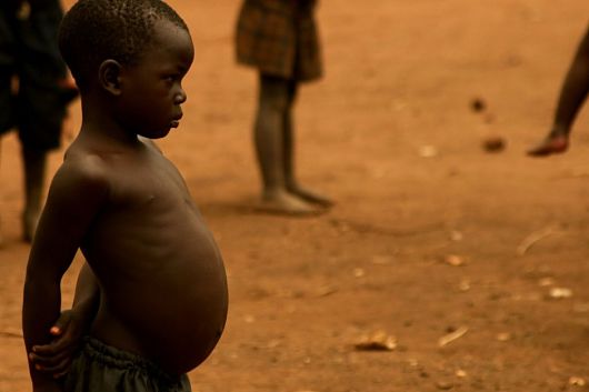 Malnourished People